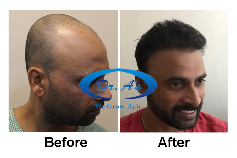 Dr Arvind Hair Transplant3.jpg
