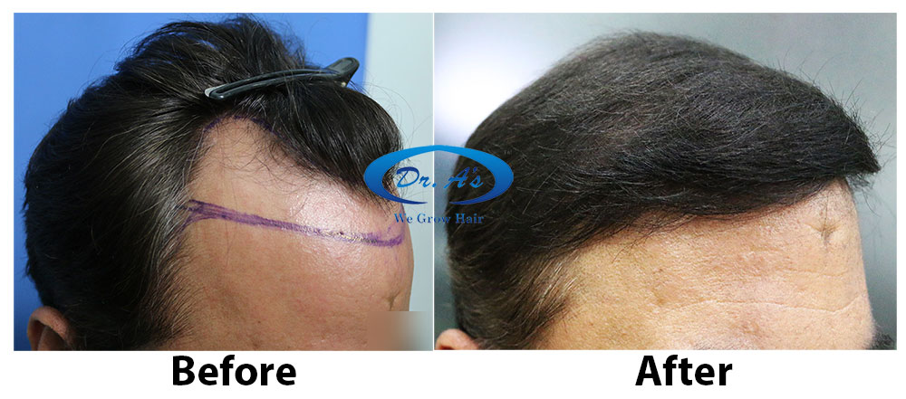 Dr Arvind Poswal hair transplant 3.jpg
