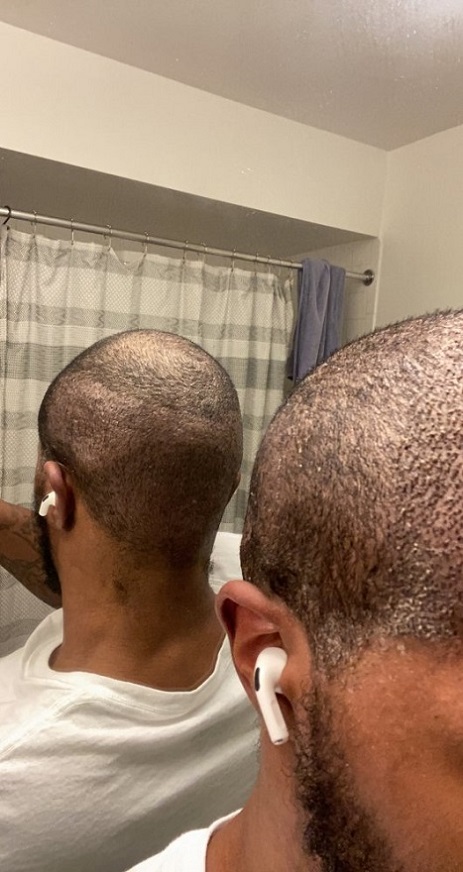 Dr Asli Tarcan FUE Hair Transplant 1.jpeg