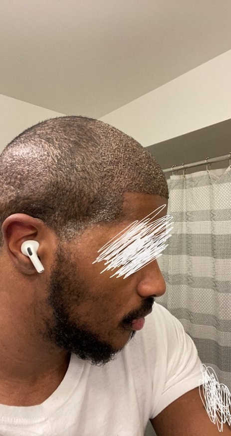 Dr Asli Tarcan FUE Hair Transplant 3.jpeg