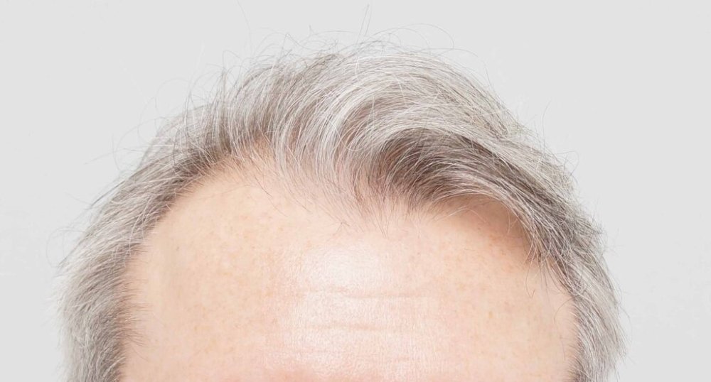 Dr. B farjo hair transplant result1.jpg