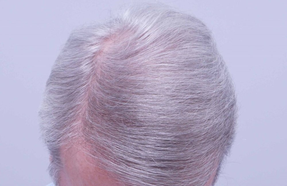 Dr. B farjo hair transplant result10.jpg