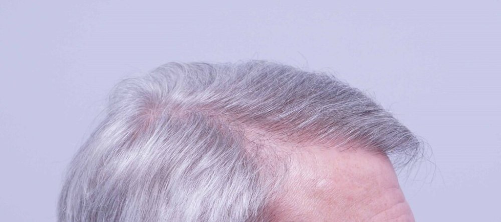 Dr. B farjo hair transplant result11.jpg