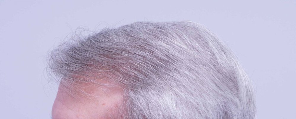 Dr. B farjo hair transplant result12.jpg