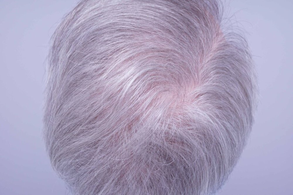 Dr. B farjo hair transplant result13.jpg