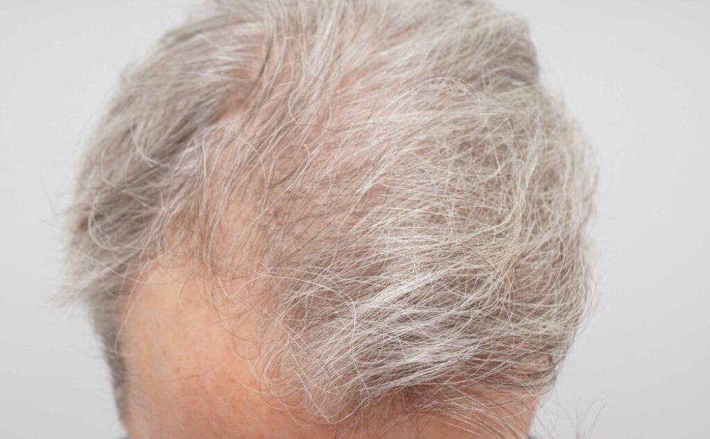 Dr. B farjo hair transplant result2.jpg