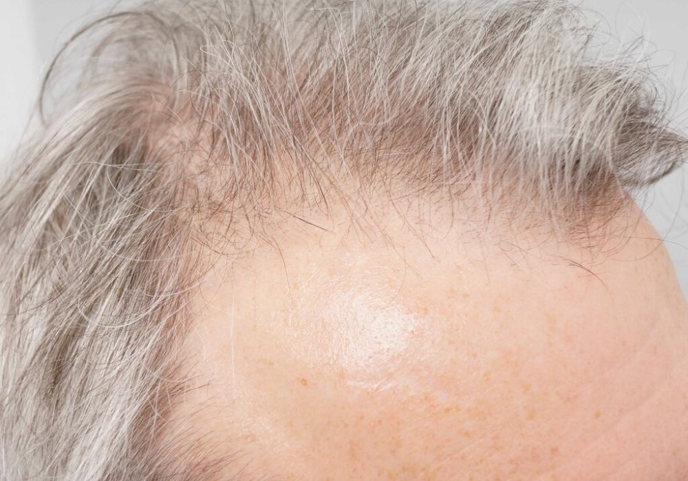 Dr. B farjo hair transplant result3.jpg