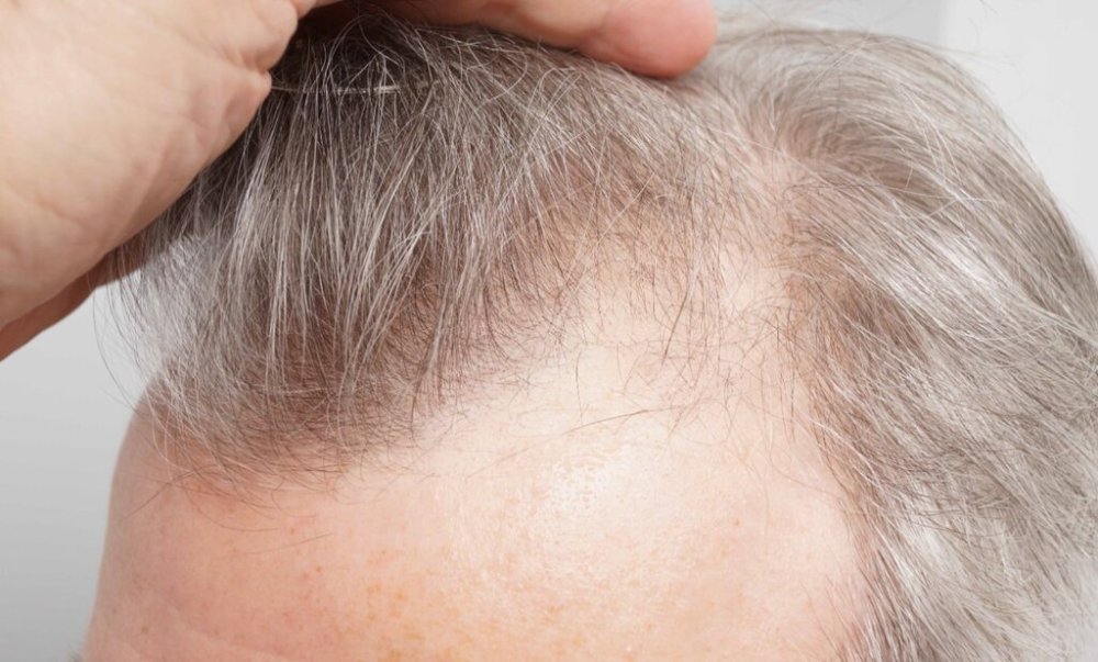 Dr. B farjo hair transplant result4.jpg