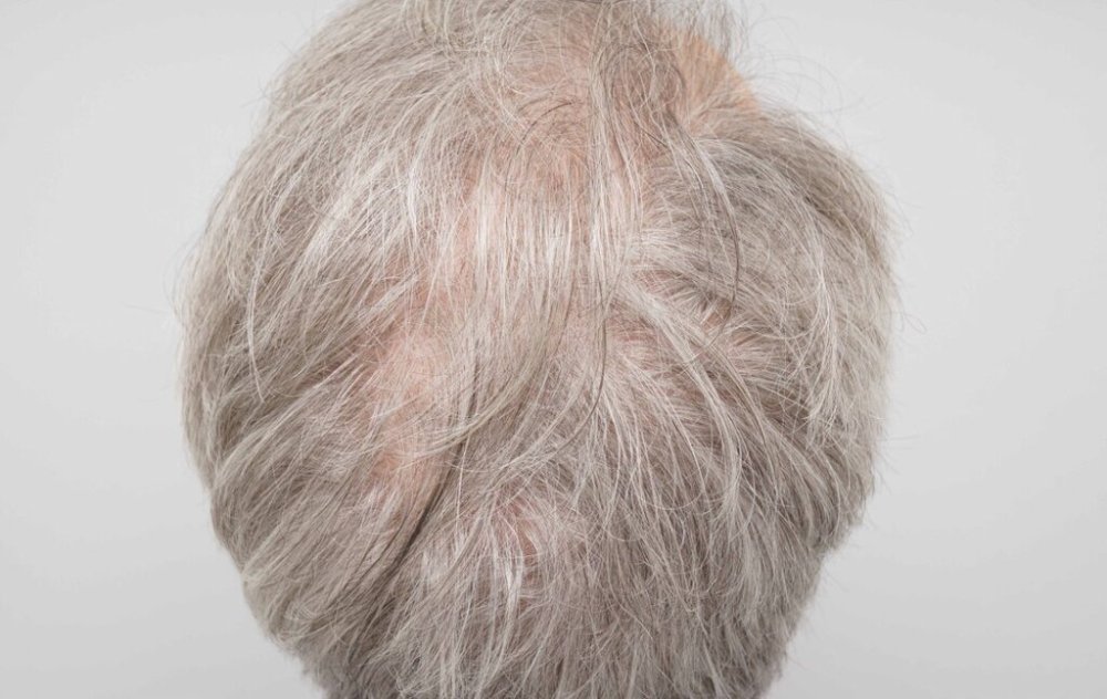 Dr. B farjo hair transplant result5.jpg