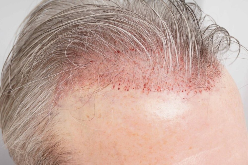 Dr. B farjo hair transplant result7.jpg