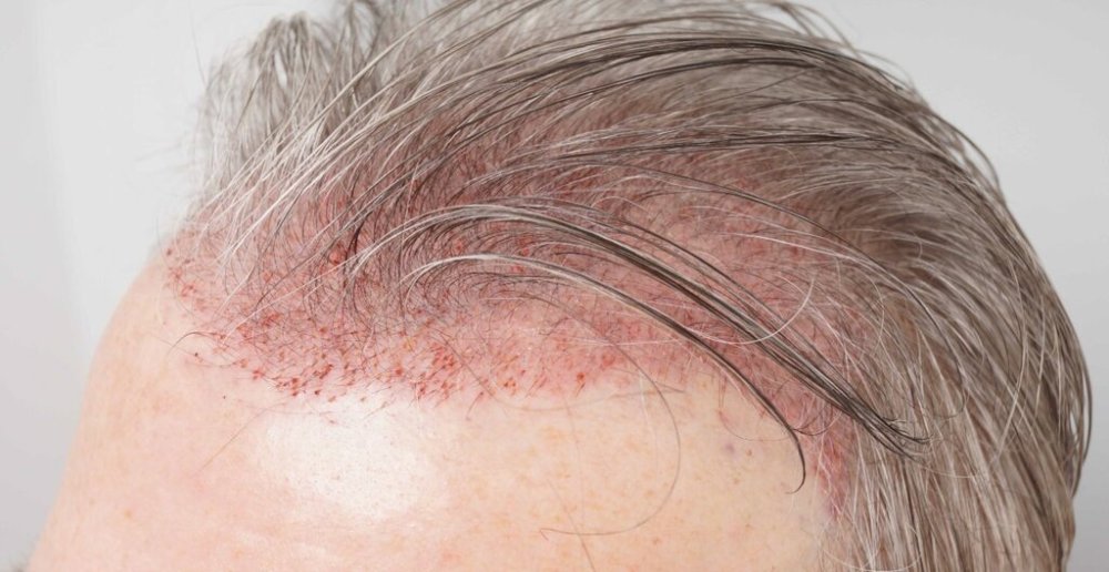 Dr. B farjo hair transplant result8.jpg