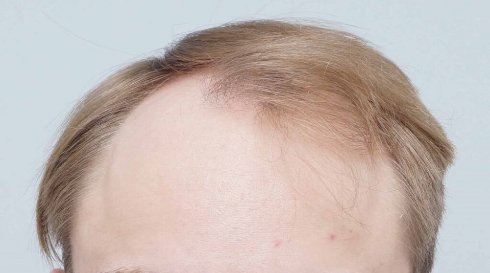 Dr B Farjo hair transplant1.jpg