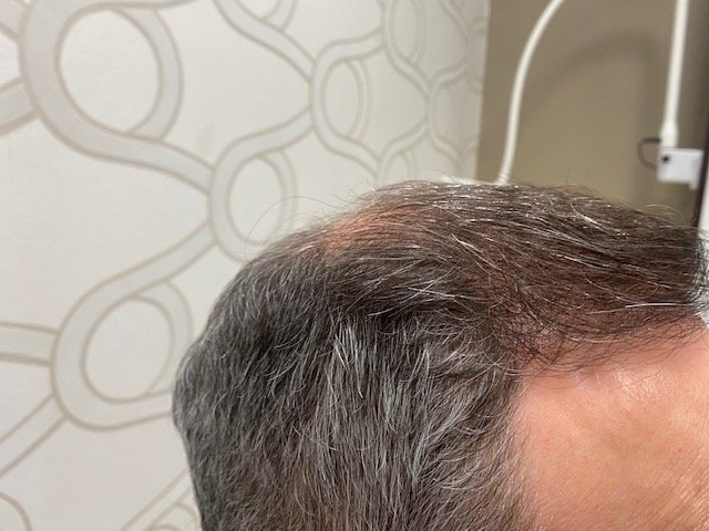 Dr. B Farjo hair transplant10.jpg
