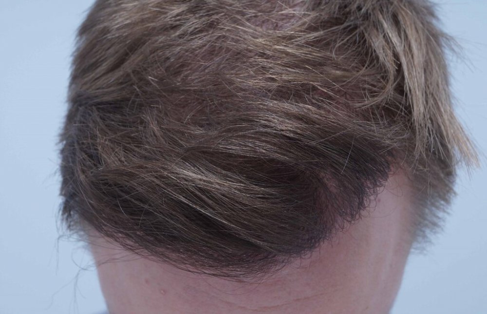 Dr B Farjo hair transplant10.jpg