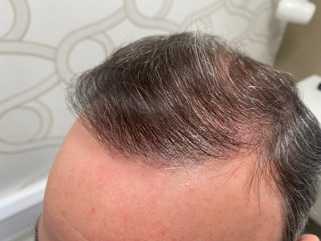 Dr. B Farjo hair transplant11.jpg