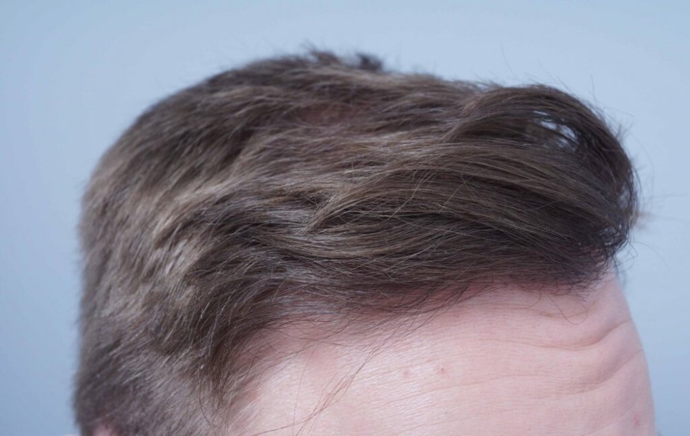 Dr B Farjo hair transplant11.jpg