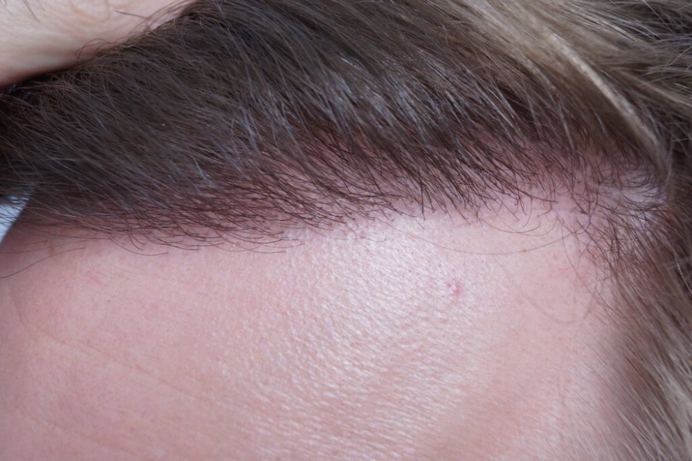 Dr B Farjo hair transplant12.jpg