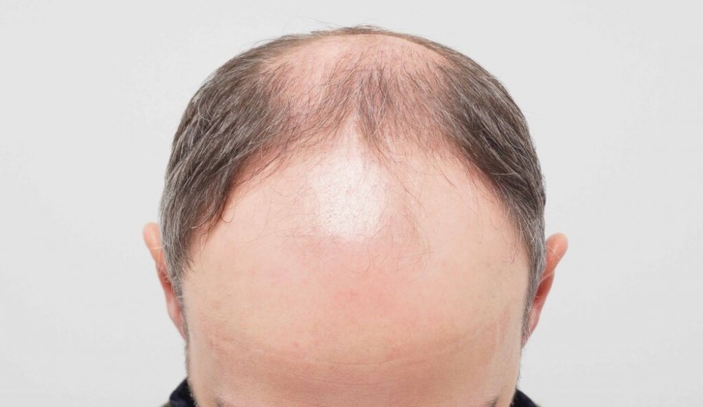 Dr. B Farjo hair transplant2.jpg