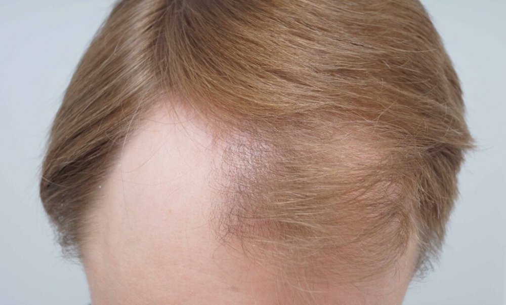 Dr B Farjo hair transplant2.jpg