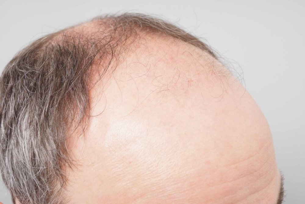 Dr. B Farjo hair transplant3.jpg