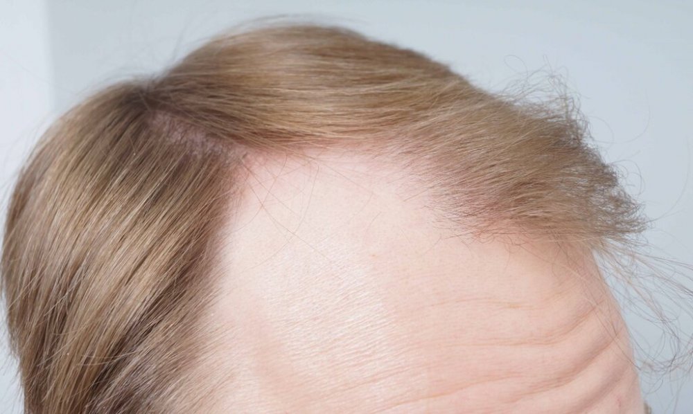 Dr B Farjo hair transplant3.jpg