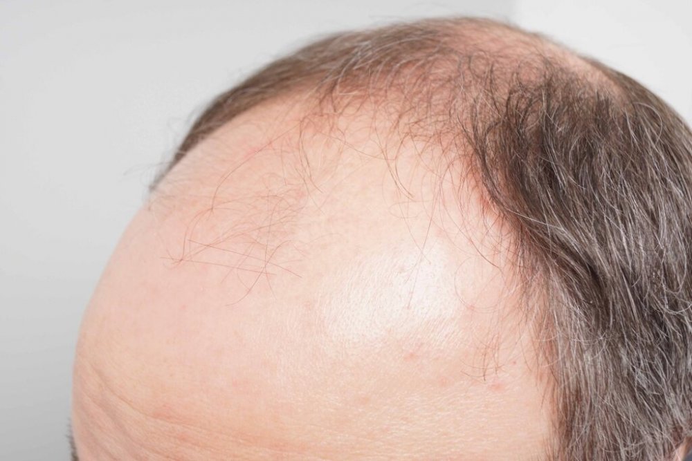 Dr. B Farjo hair transplant4.jpg