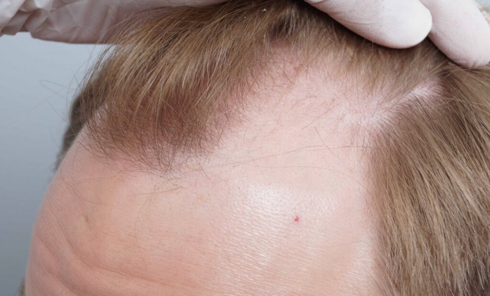 Dr B Farjo hair transplant4.jpg
