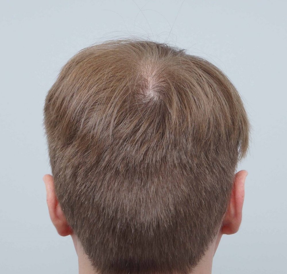 Dr B Farjo hair transplant5.jpg