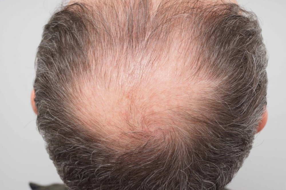 Dr. B Farjo hair transplant6.jpg