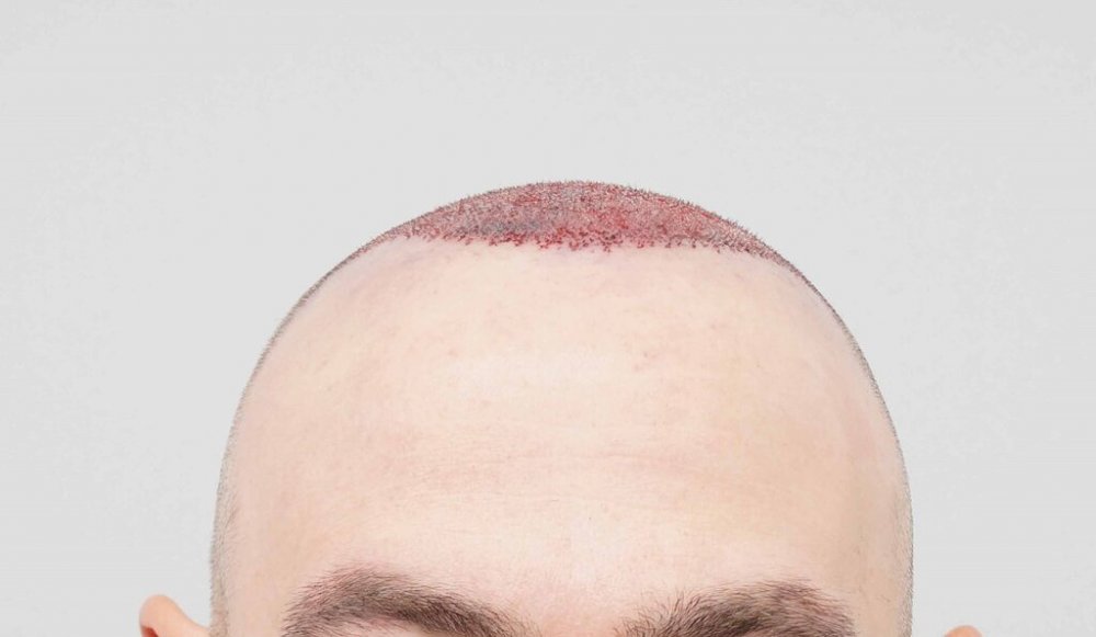 Dr. B Farjo hair transplant7.jpg