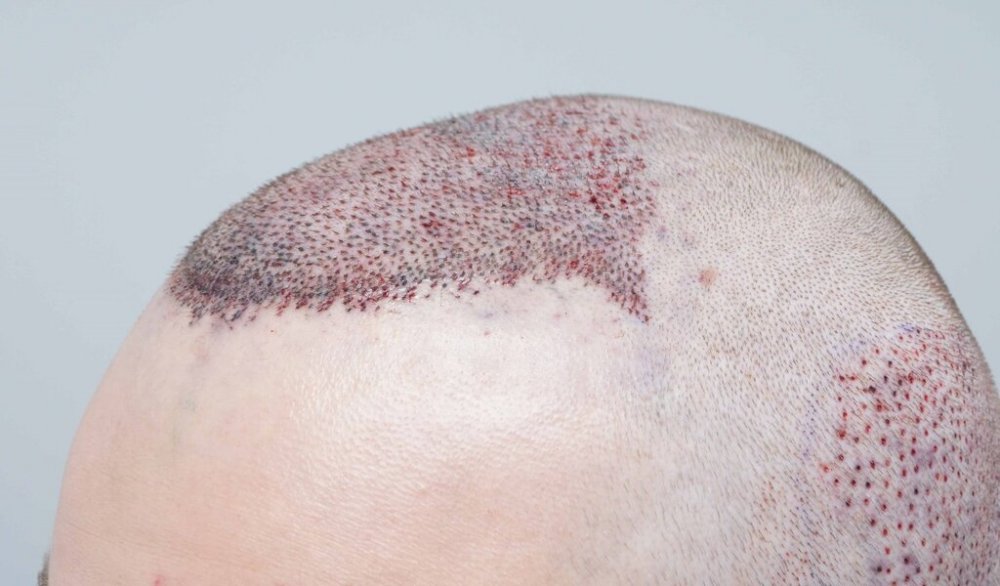 Dr B Farjo hair transplant7.jpg