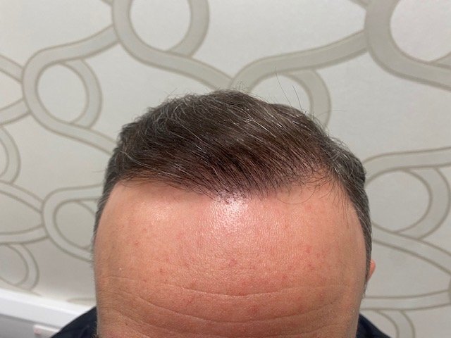 Dr. B Farjo hair transplant8.jpg