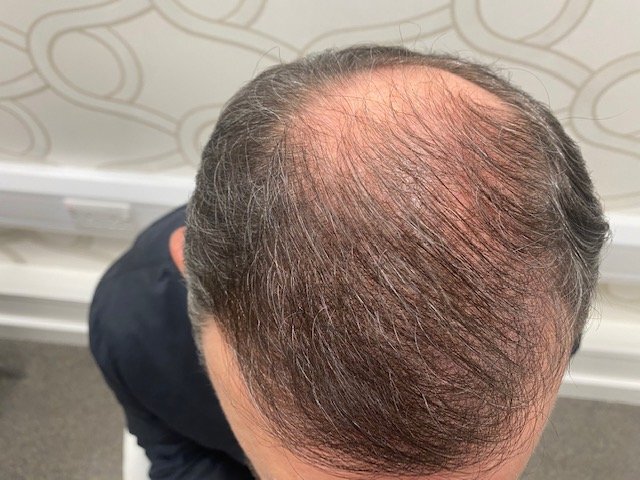 Dr. B Farjo hair transplant9.jpg