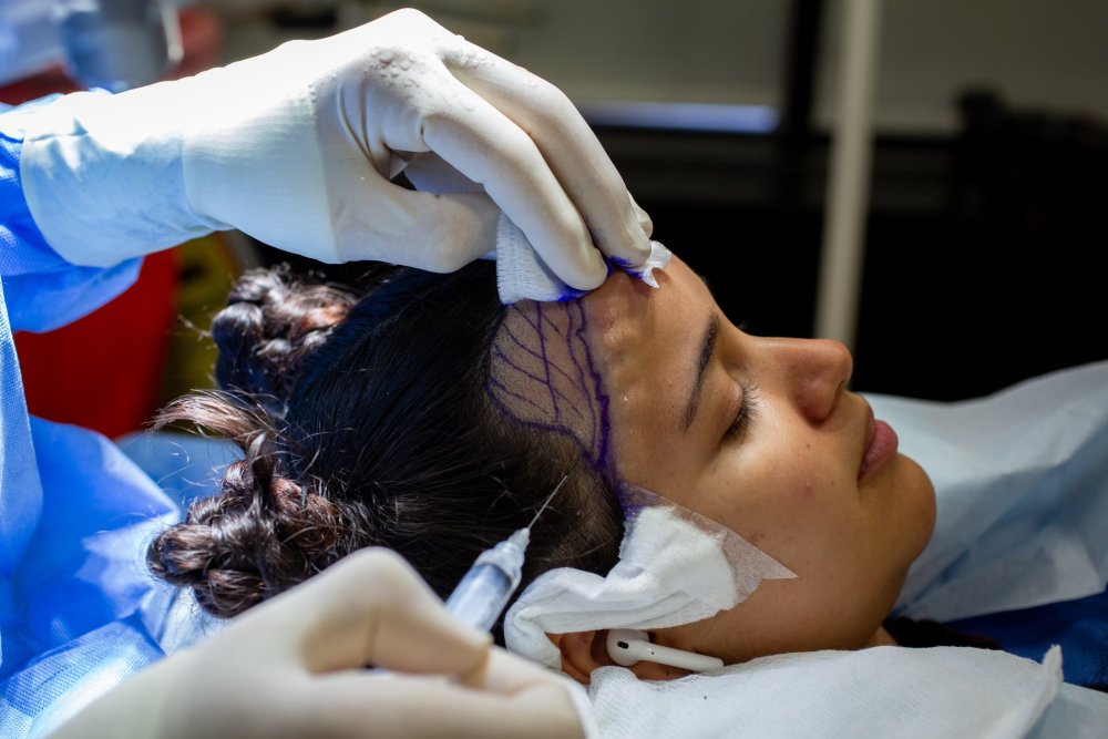 Dr Ball injecting local anaesthetic during Aria's hairline lowering hair transplant