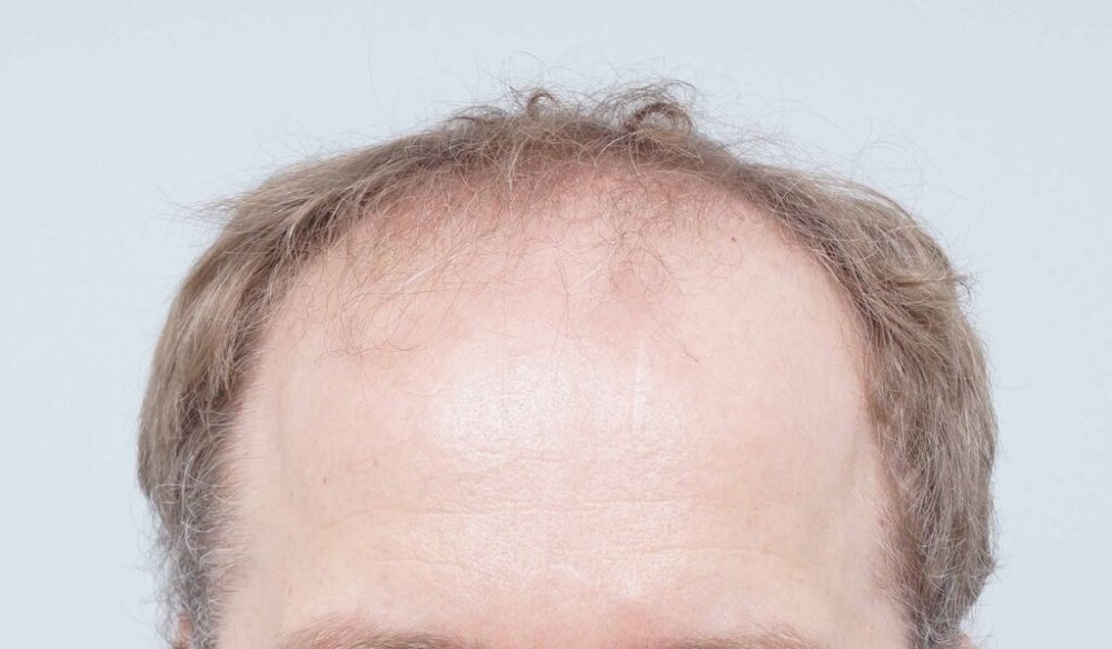 Dr Bessam Farjo Hair Transplant Result1.jpg