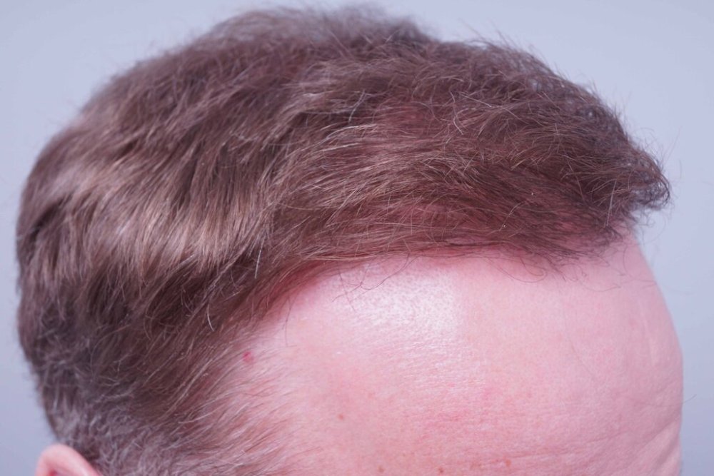 Dr Bessam Farjo Hair Transplant Result10.jpg