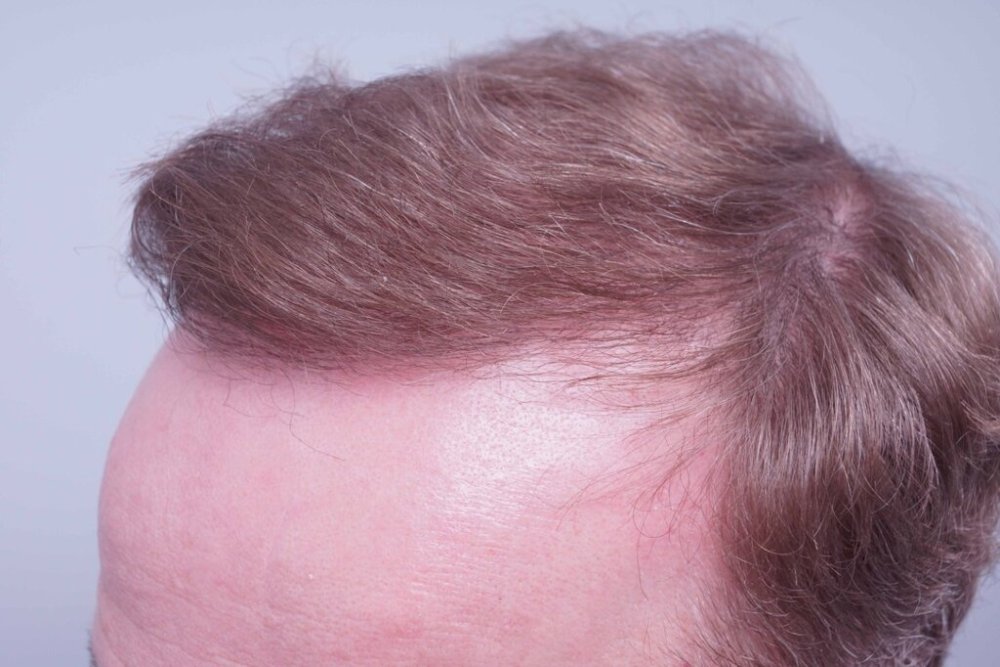 Dr Bessam Farjo Hair Transplant Result11.jpg