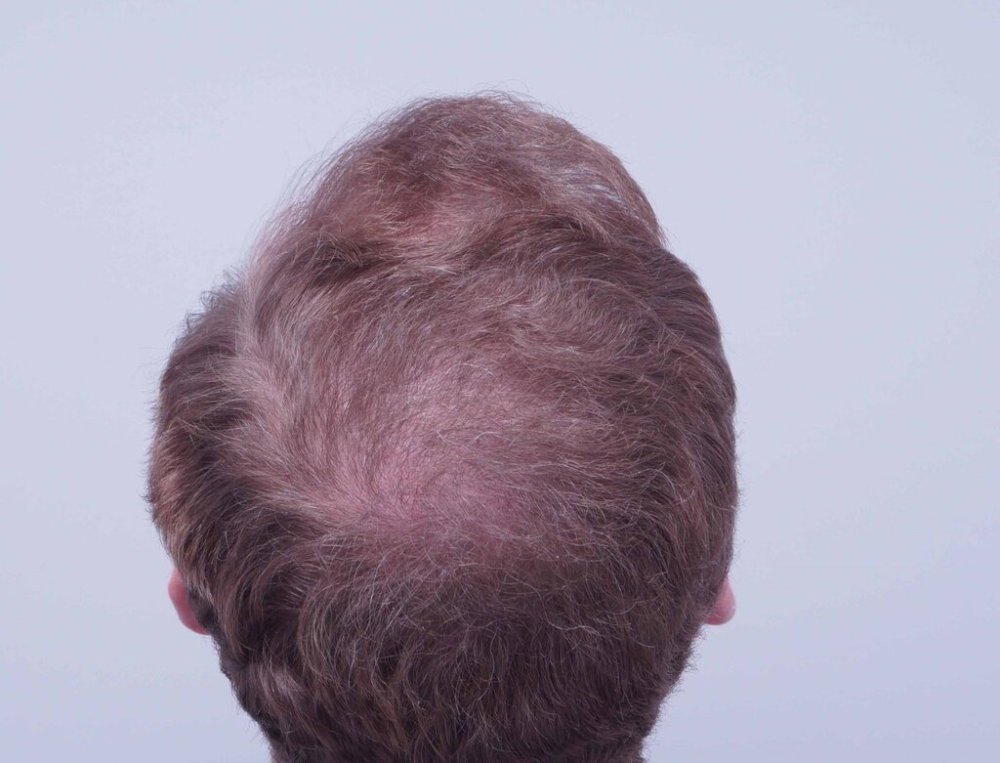 Dr Bessam Farjo Hair Transplant Result12.jpg