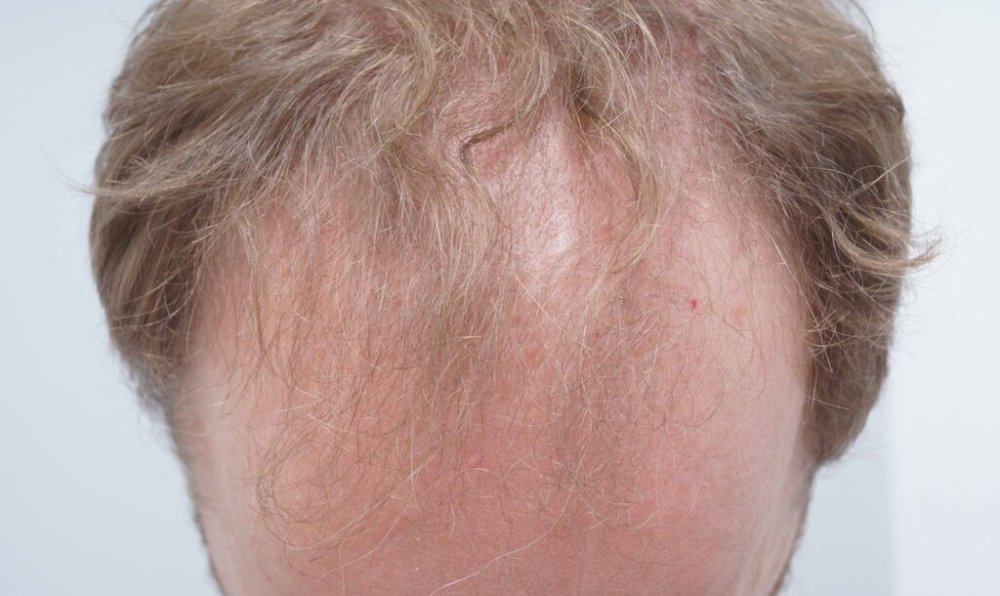 Dr Bessam Farjo Hair Transplant Result2.jpg