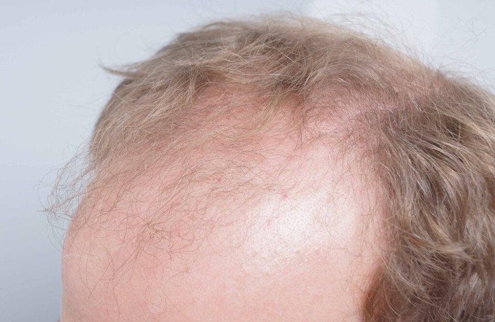Dr Bessam Farjo Hair Transplant Result3.jpg