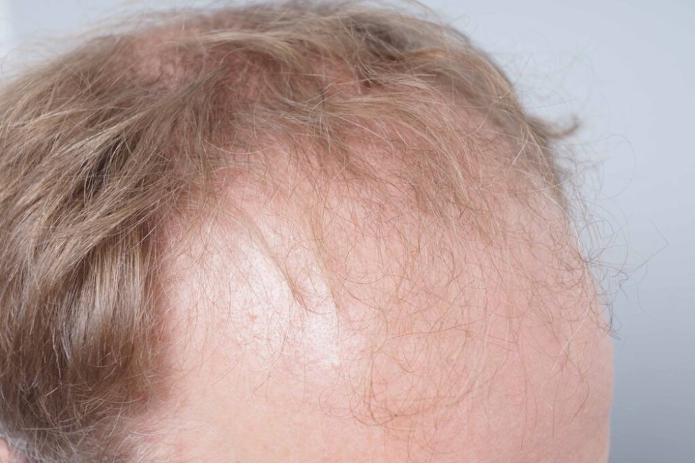 Dr Bessam Farjo Hair Transplant Result4.jpg