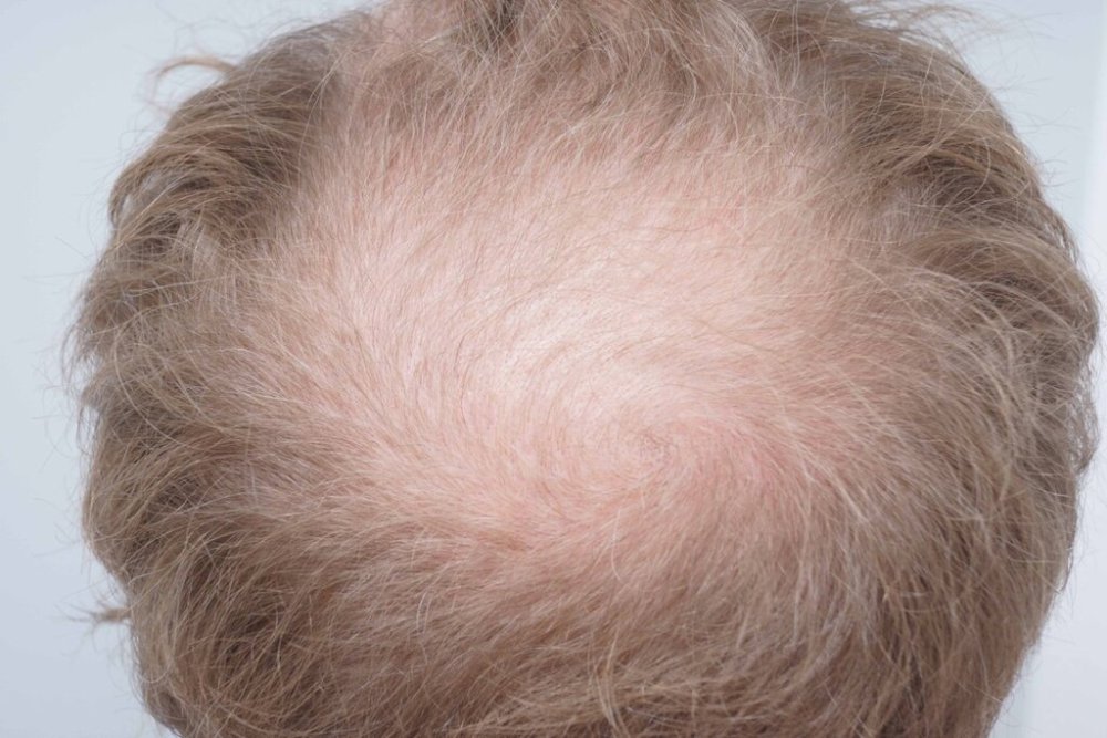 Dr Bessam Farjo Hair Transplant Result5.jpg