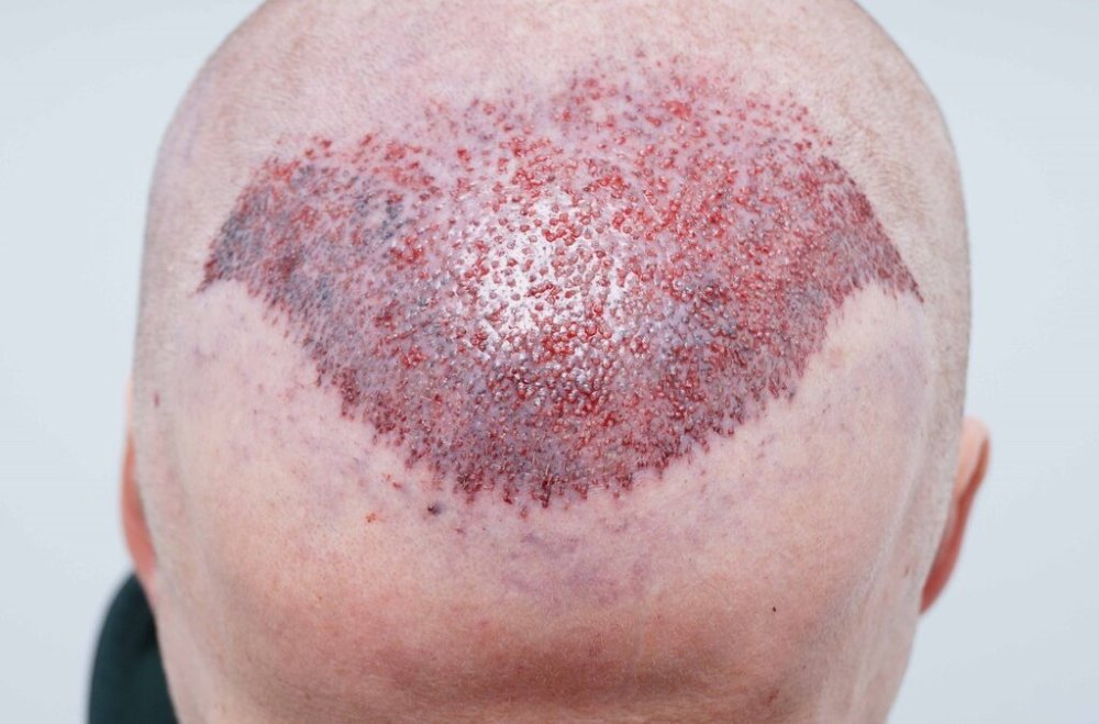 Dr Bessam Farjo Hair Transplant Result6.jpg