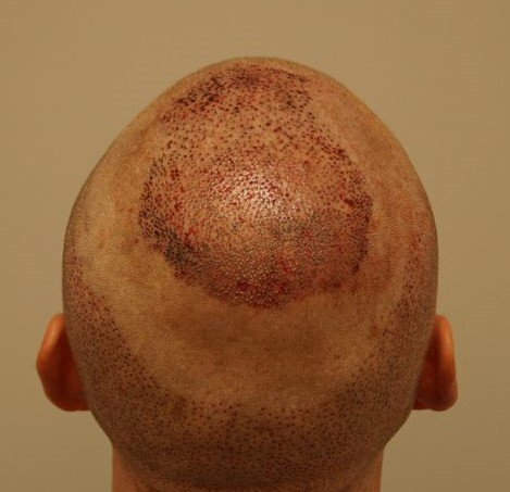 Dr Bessam Farjo Hair Transplant Result7.jpeg
