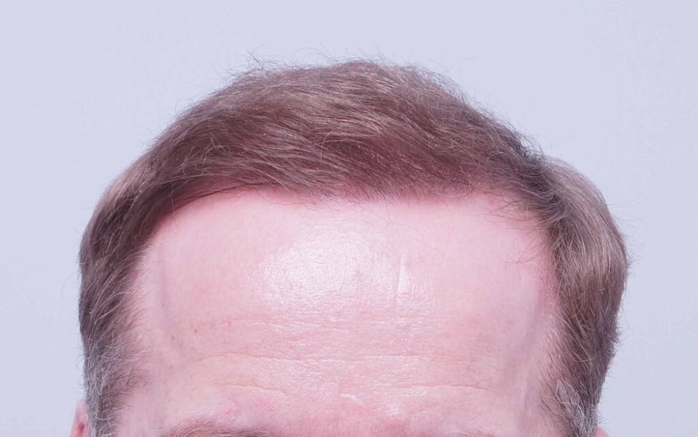Dr Bessam Farjo Hair Transplant Result8.jpg