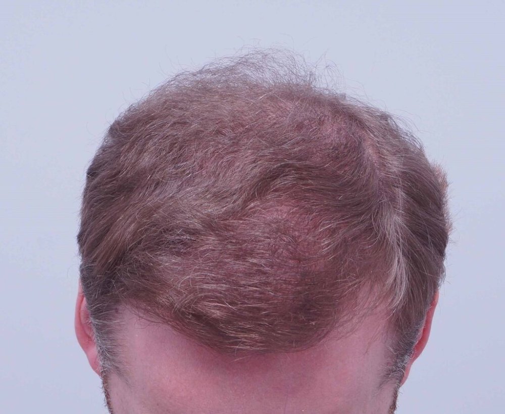 Dr Bessam Farjo Hair Transplant Result9.jpg