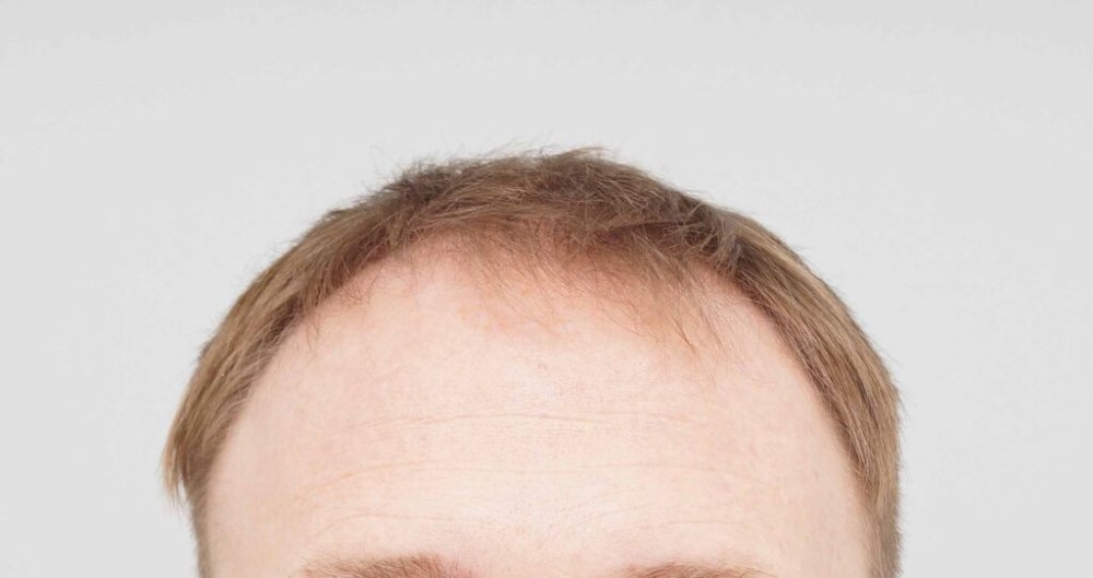 Dr. Bessam Farjo hair transplant1.jpg