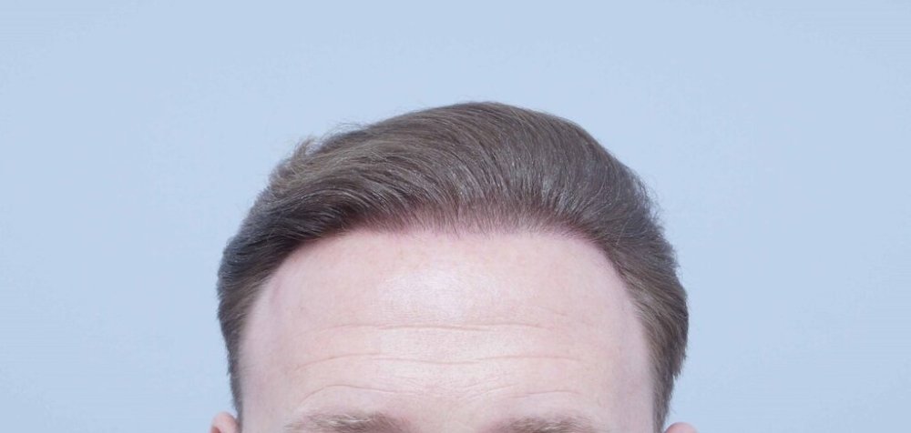 Dr. Bessam Farjo hair transplant10.jpg