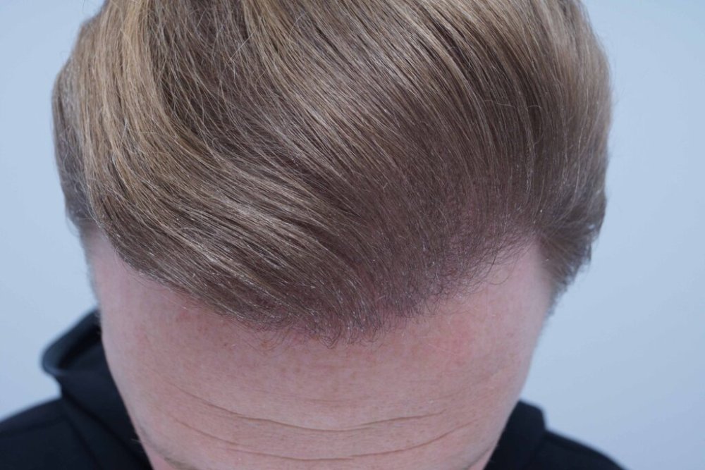 Dr. Bessam Farjo hair transplant11.jpg