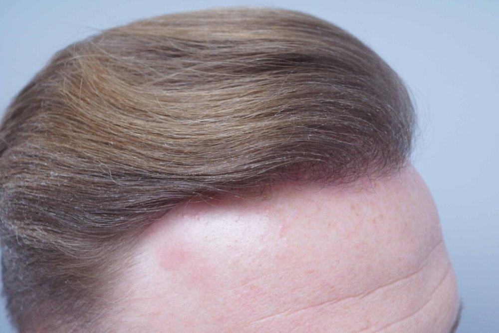 Dr. Bessam Farjo hair transplant12.jpg